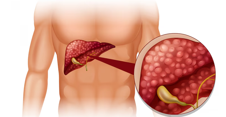 Pancreatic Cancer Treatment in Hyderabad by Dr. Vijay Karan Reddy